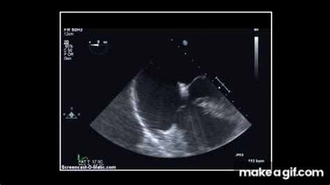 good lv|british heart foundation echocardiogram.